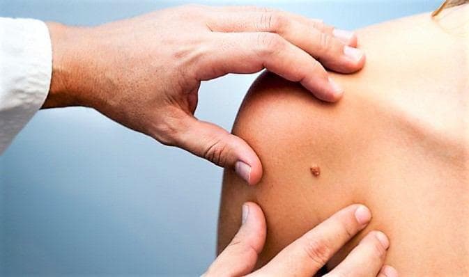 Видалення папілом